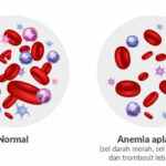 Inilah Ciri - ciri Anemia Aplastik yang Wajib Diketahui