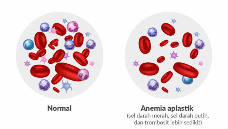 Inilah Ciri - ciri Anemia Aplastik yang Wajib Diketahui