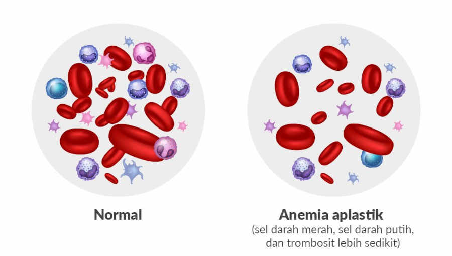 Inilah Ciri - ciri Anemia Aplastik yang Wajib Diketahui